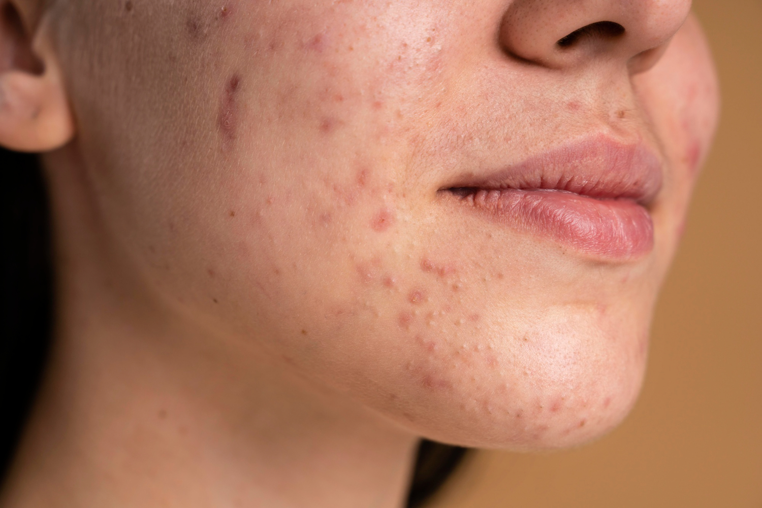 The Different Types of Acne and How to Treat Them